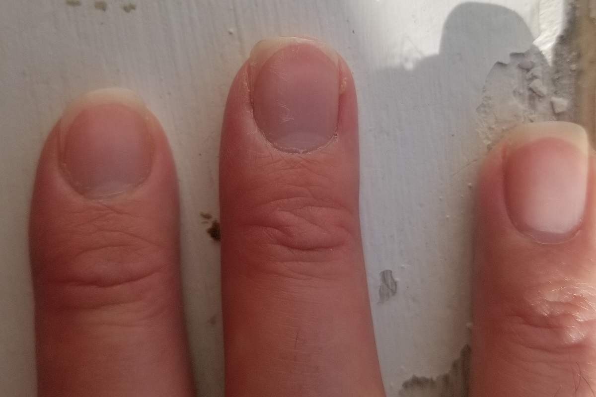 A picture of right hand fingernails and the shape of the middle fingernail after a break playing fingerstyle guitar